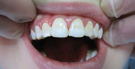 Гипоплазия эмали зубов 