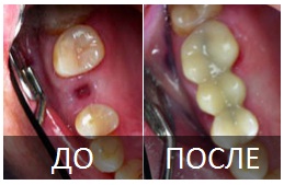 Микропротезирование зубов. Фото до и после микропротезирования.