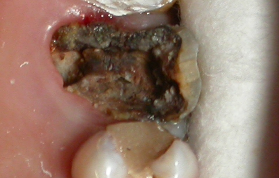 Разрушенный зуб