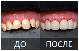 Реставрация зубов (художественная, эстетическая)