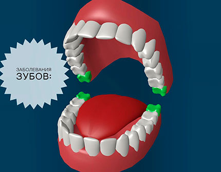 Какие заболевания зубов встречаются чаще всего?